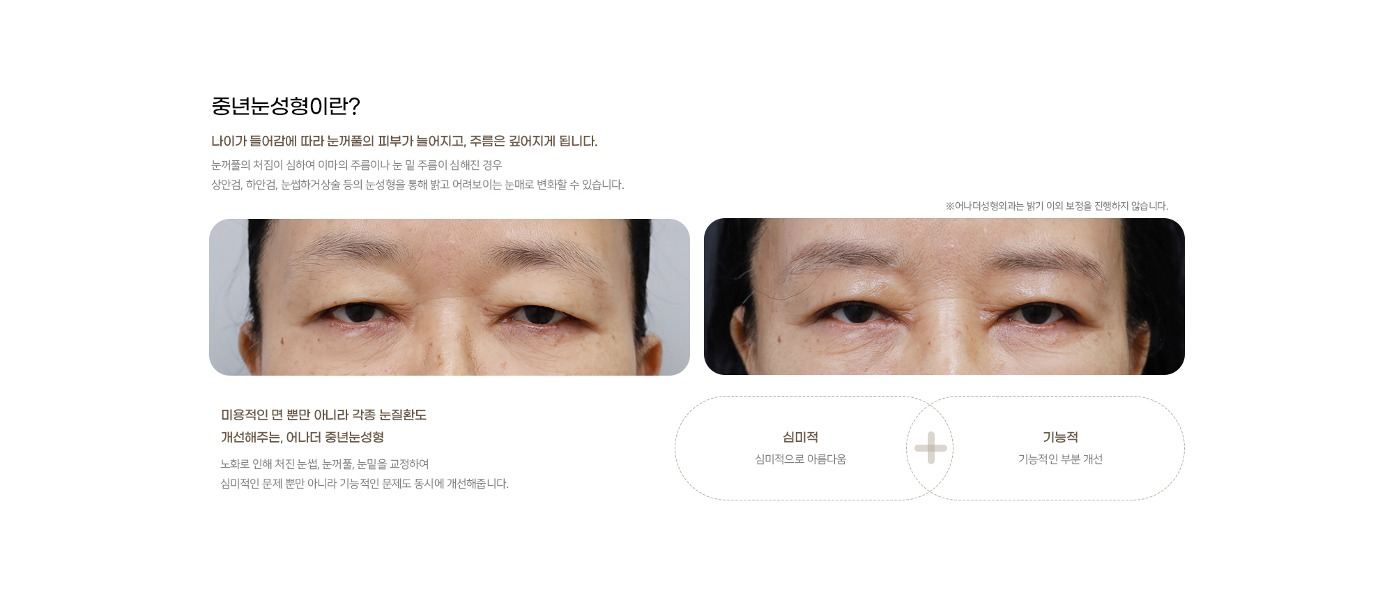 중년눈성형